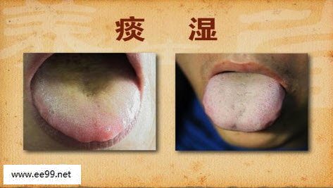 怎样判断痰湿体质痰湿体质有什么症状