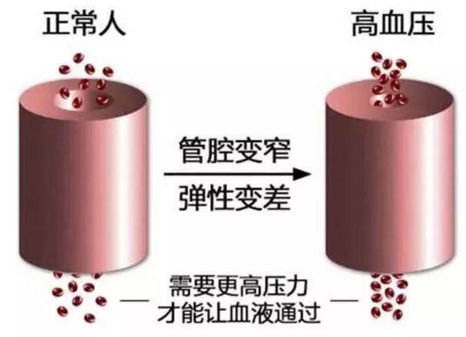 高血压要一辈子吃药吗