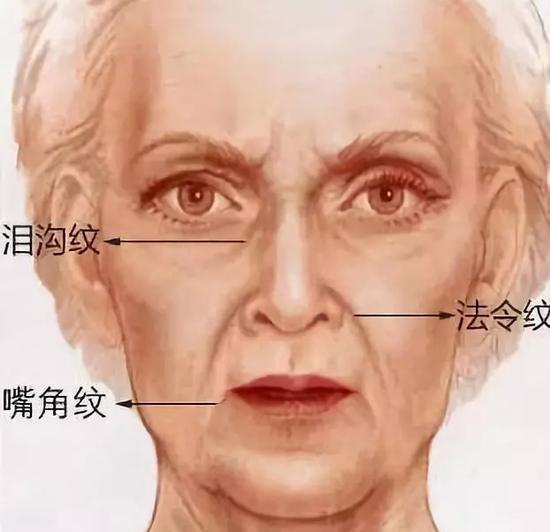 法令纹,木偶纹,三八纹,泪沟纹,图